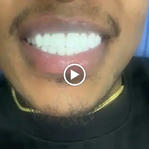 Bright smile after professional teeth whitening in Ota