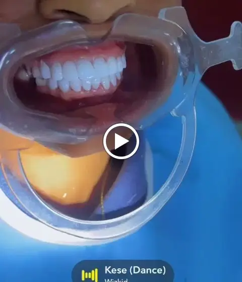 Dental Bonding care in Ota, Ogun State