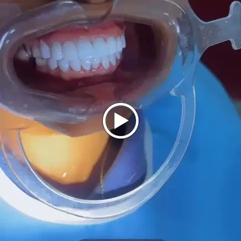 Smile after tooth colored veneers fitting