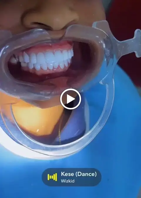Veneers at Royal Aesthetics Dental Clinic in Ota