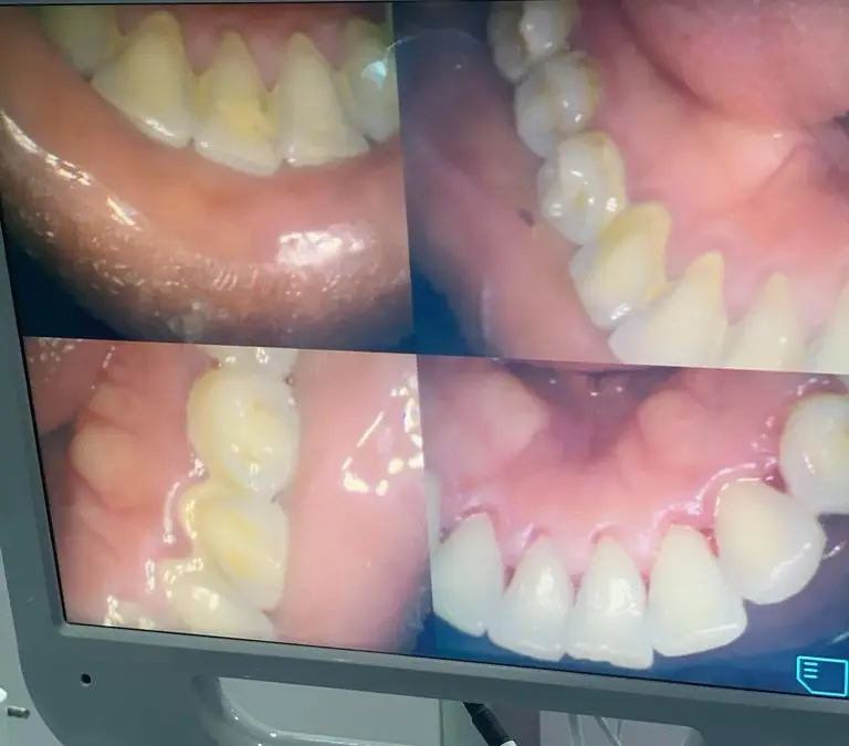 Digital Dental X-Rays at Royal Aesthetics Dental Clinic in Ota