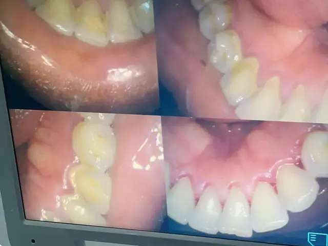 Intraoral camera images of teeth shown on a clinic monitor