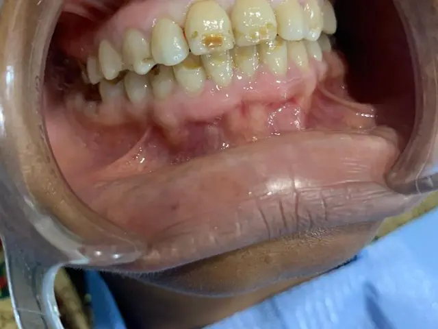 Stained teeth before professional dental cleaning
