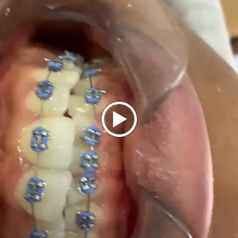 Orthodontic braces fitted on a patient