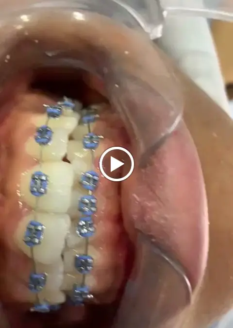 Braces at Royal Aesthetics Dental Clinic in Ota